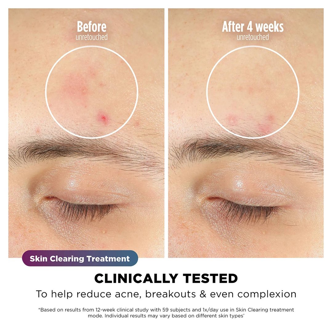 Shark CryoGlow Under-Eye Cooling + LED Face Mask - Lilac FW312PL